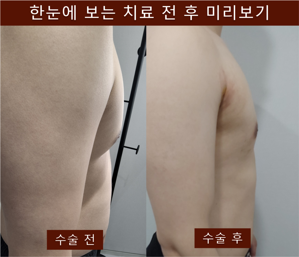 치료스토리 - 여유증 수술 시 유륜 축소도 필요할까? 강남비뇨기과 유선 제거 집중 치료 사례
